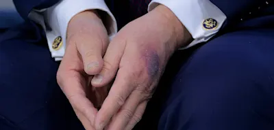 &bdquo;Nehmen Sie Aspirin, wenn Ihnen Ihr Herz lieb ist&ldquo; &ndash;&nbsp;Trump &auml;u&szlig;ert sich zu Bluterguss auf seiner Hand